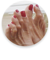 Hammertoes
