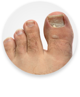 Ingrown Toenails