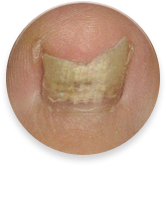 Toenail Fungus
